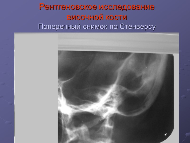 Рентгеновское исследование  височной кости Поперечный снимок по Стенверсу